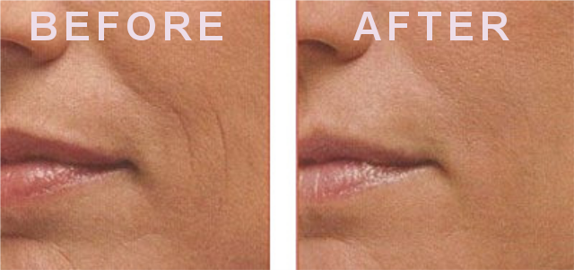 Miracle Matrixyl 3000 Anti-aging Serum